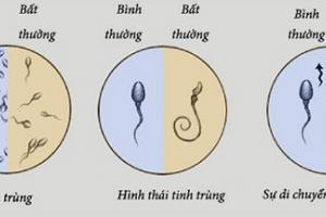 Nam giới nên thận trọng với 4 loại thực phẩm gây hại cho tinh trùng