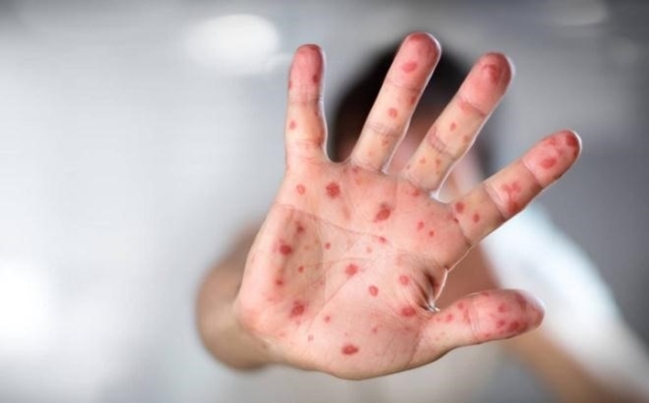 Bộ Y tế nói về việc thiếu thuốc điều trị tay chân miệng ở phía Nam
